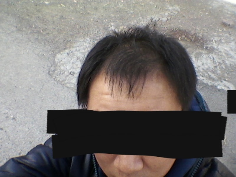 수술 당일날 아침.png