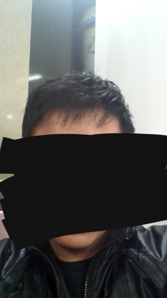 수술 1년 후-2.png