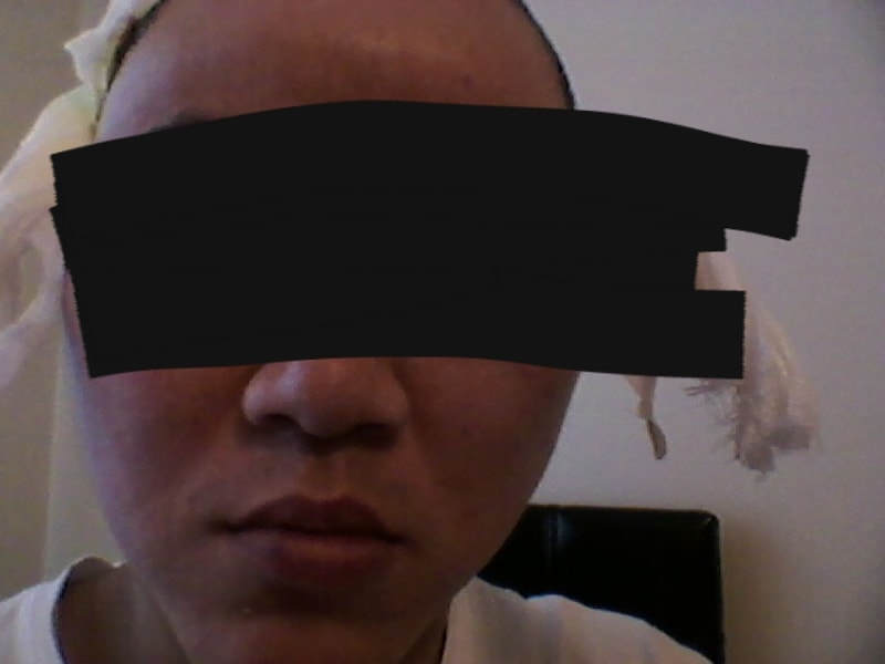 수술 2일후 붓기심함.png