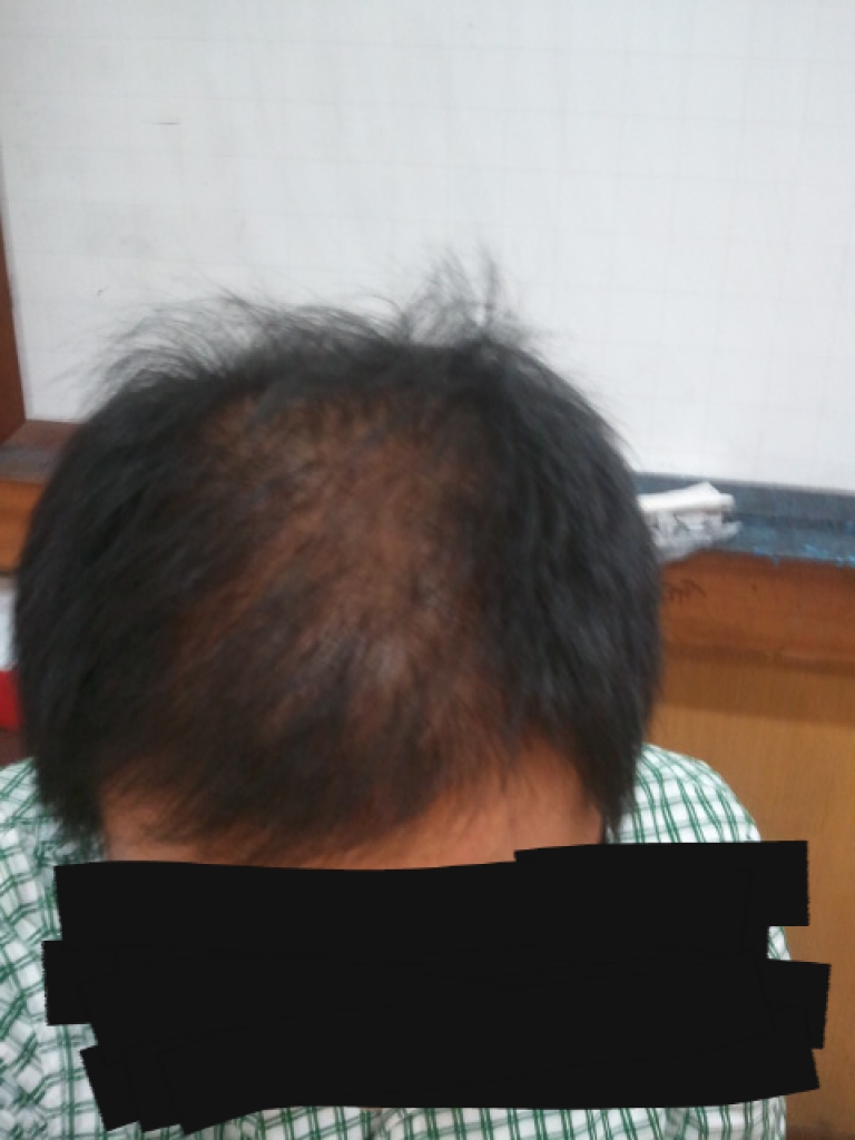 수술 6달 후.png
