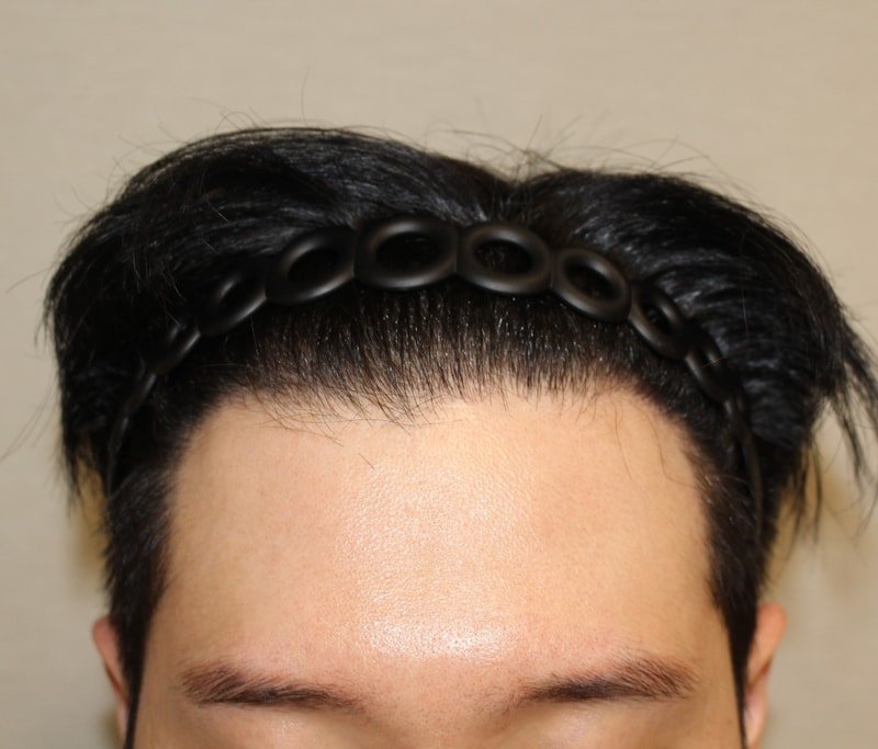 모다올의원 홍준현 원장님 비절개 모발이식 6개월차 후기