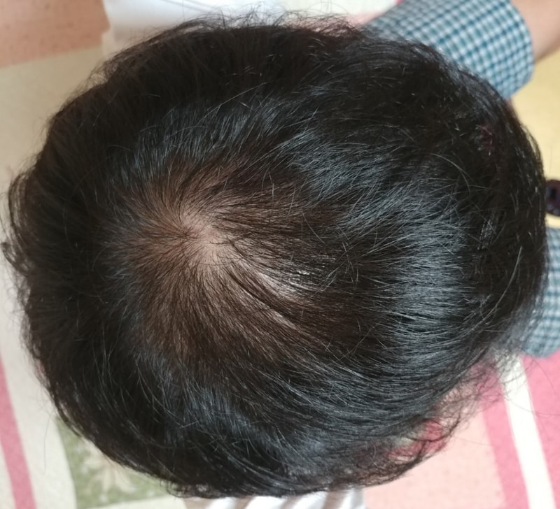 모발이식 수술 비절개 1년 차 후기 입니다.