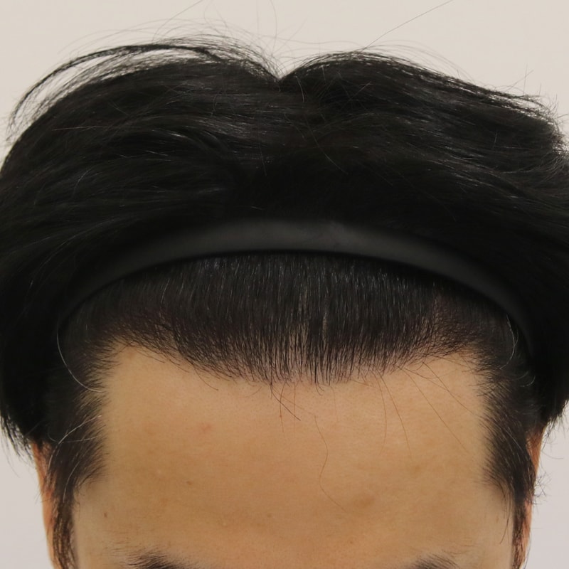 Two weeks have passed since Busan Hair transplant M-shaped incision! [Mammoth hairline]