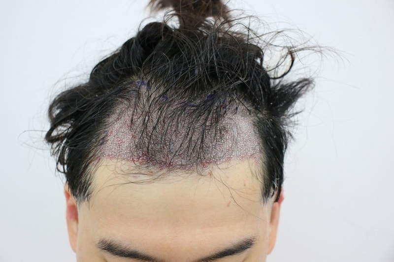 포헤어 1800모낭 12월 28일 수술사진입니다.