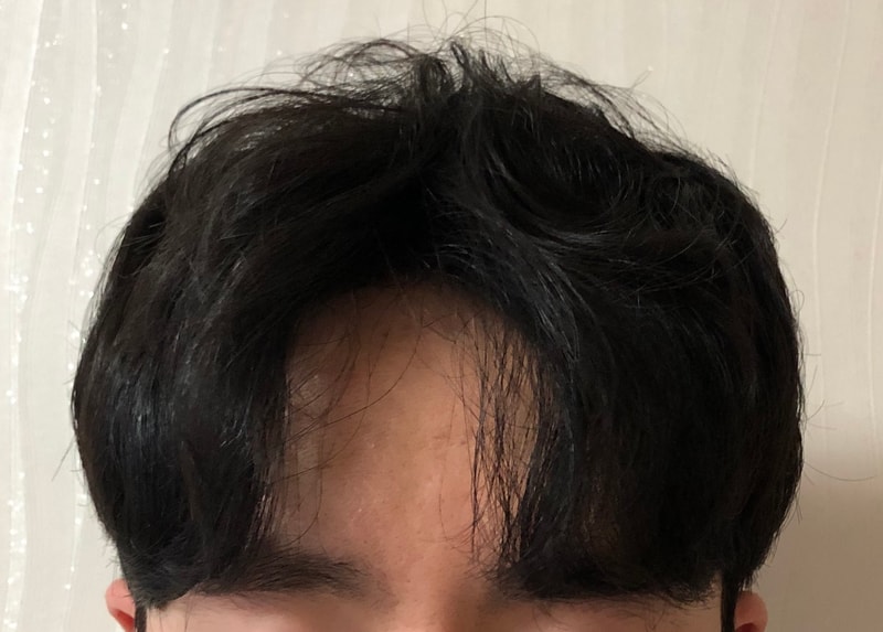 이식 후 1년이 지났습니다!