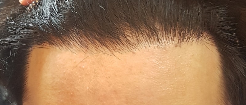1400모낭 모발이식 9개월차 세 번째 평가