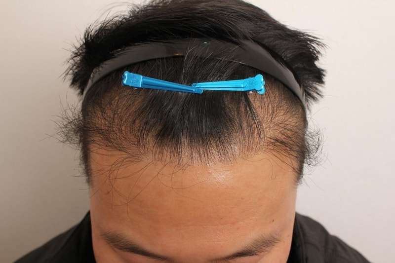 11개월경과 (3).JPG