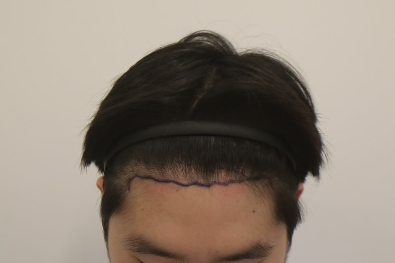 부산 맘모스 M자 2차 이식(보강 재수술) 1년 경과 후기