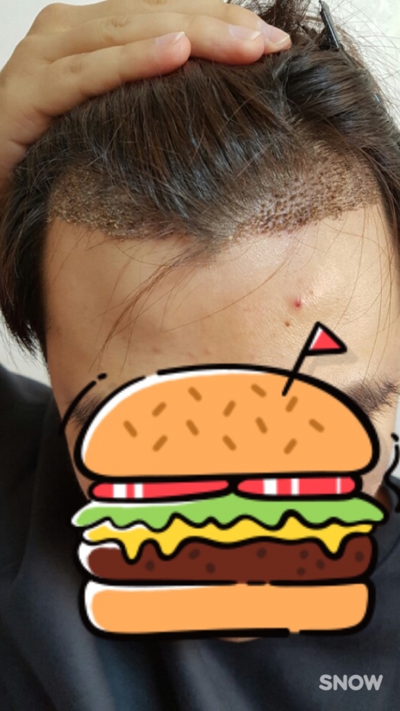 비절개 슬릿으로 포헤어에서 했습니다