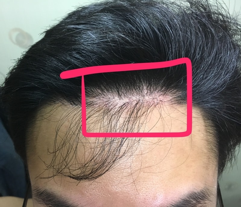 as받으려는데 몇모낭이나 필요할까요??