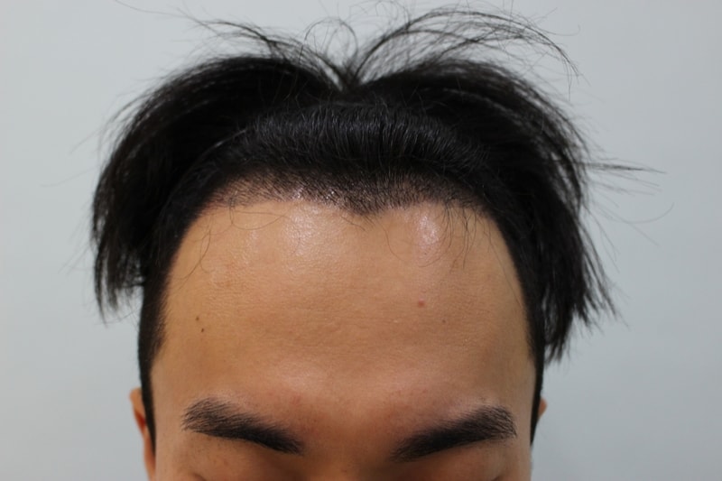 수술후 15일 (7).JPG