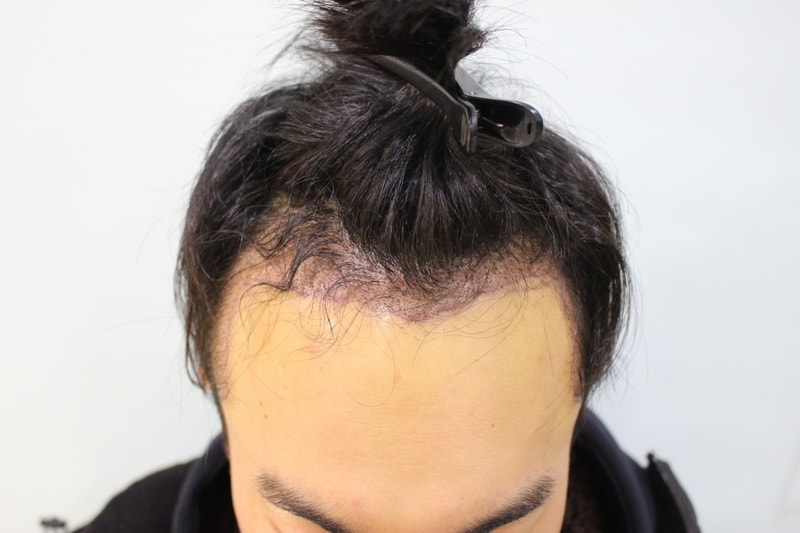 수술후 1일 (1).JPG