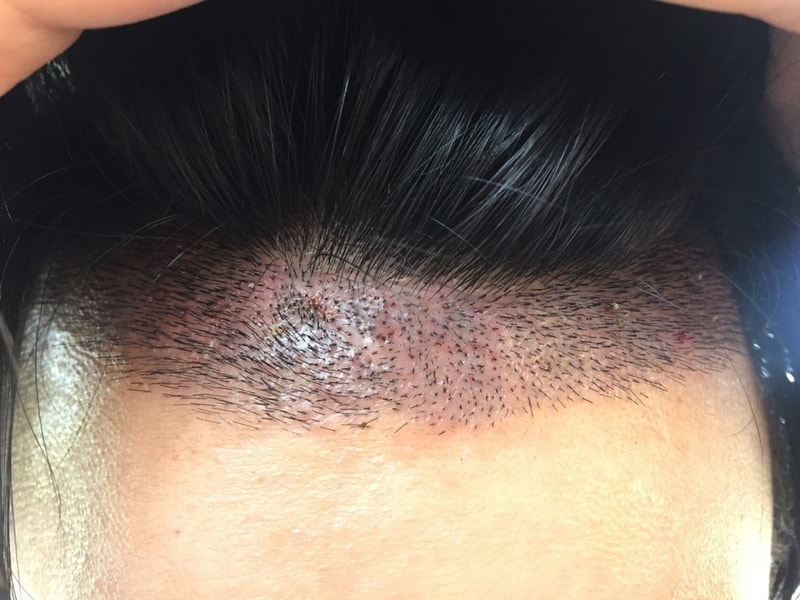 nhi뉴헤어 1446모낭 10일차후기