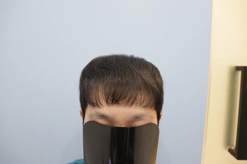 광주압구정모비앙의원 모발이식 10개월경과후기