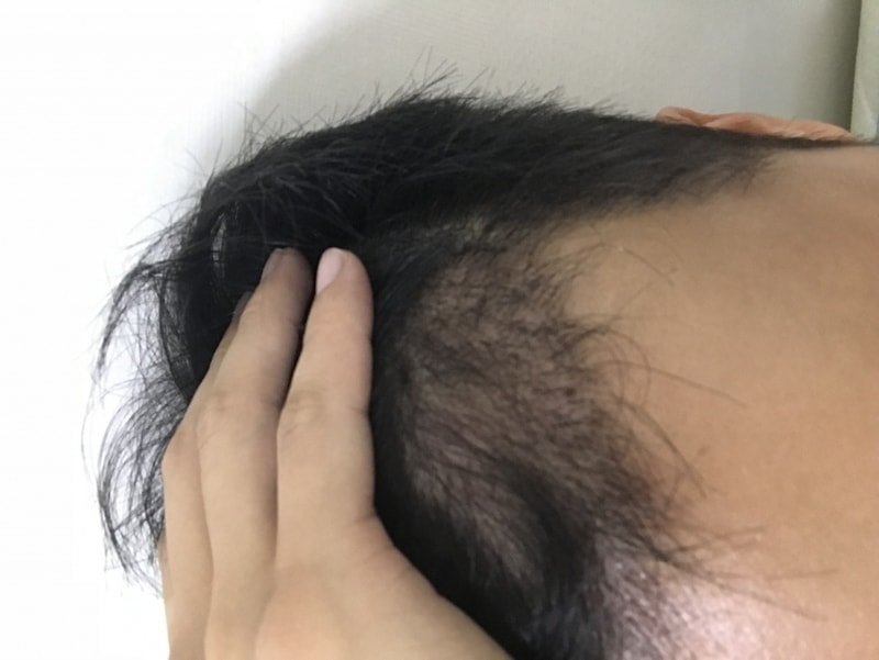 모재성 비절개 약4개월차+후두부