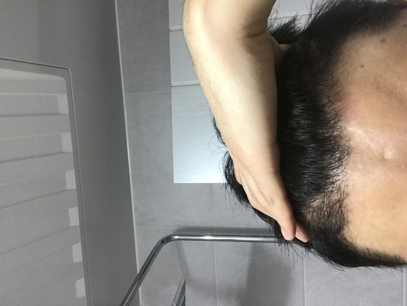 모재성 비절개 4개월 후기입니다.!!