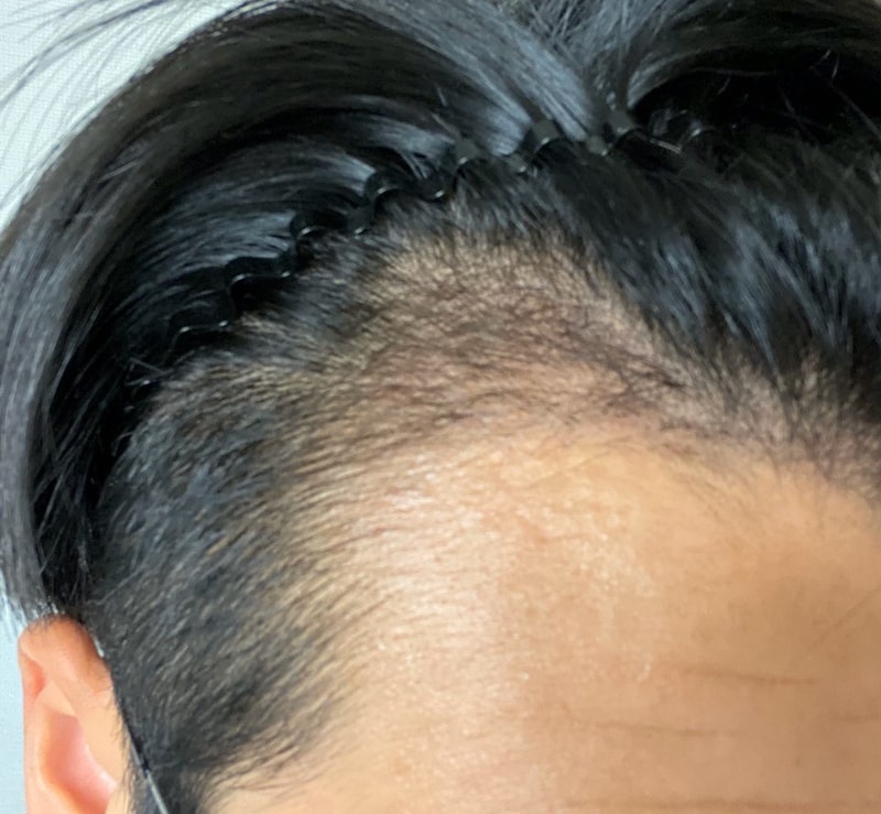 다나 절개 3개월차 상태 체크 부탁드려요