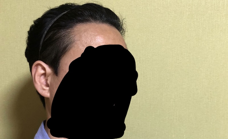 다나 롱헤어무삭발 6개월1주