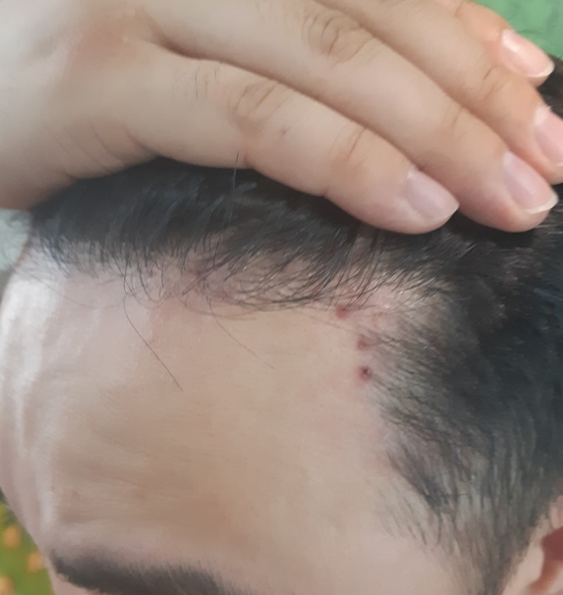 시술전 오.jpg