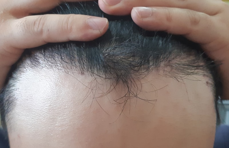 시술전 정면1.jpg