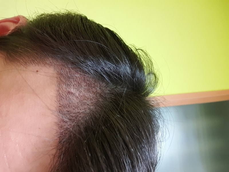 11일차 딱지제거