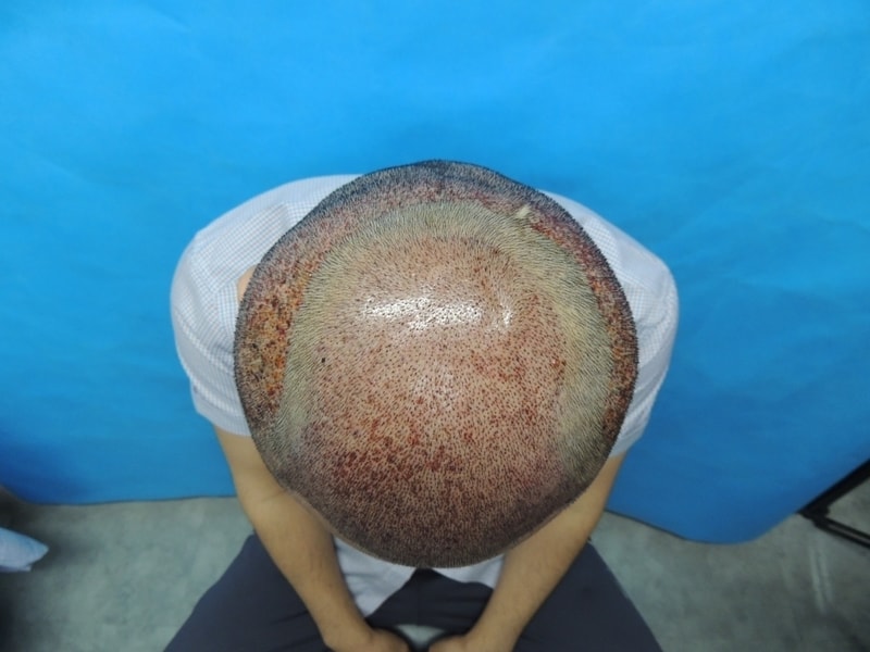 수술 1일후 3.JPG