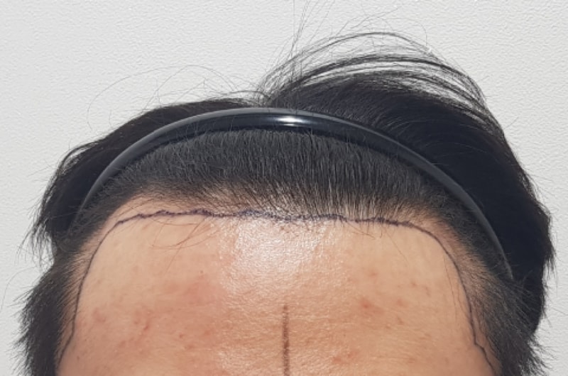 비절개 모발이식(2,500모) 80일차입니다. 한번 봐주세요