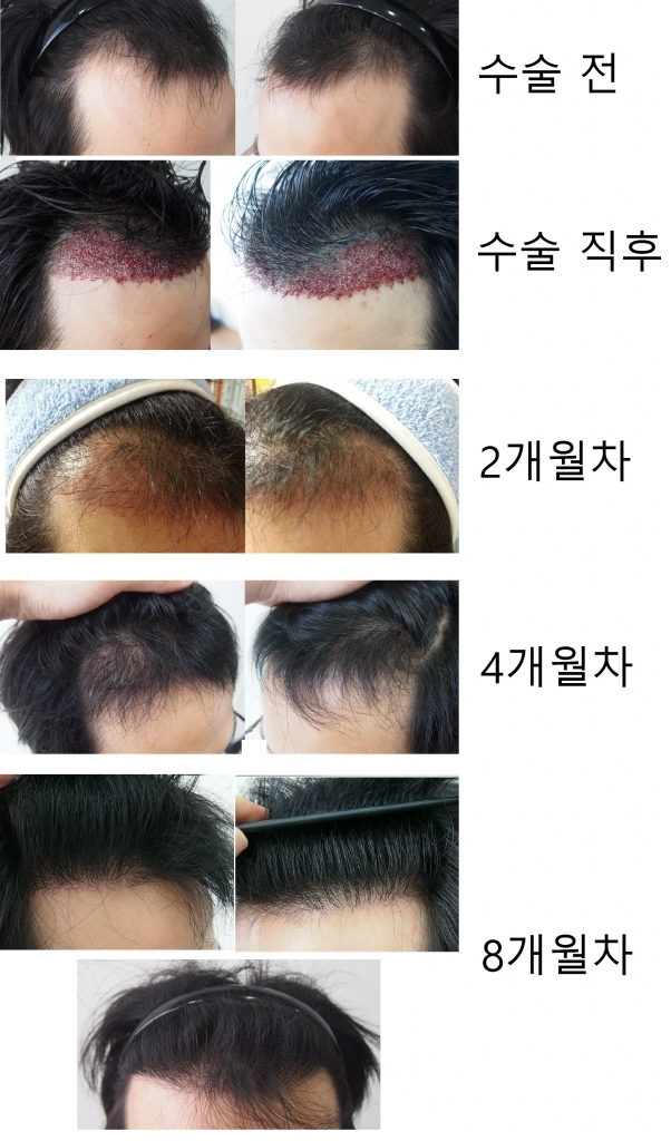 모재성 비절개 1500모낭 8개월 경과 후기입니다.