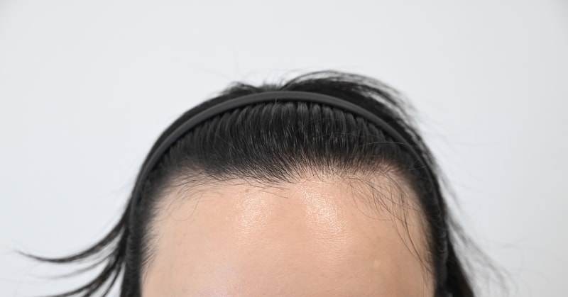 헤어라인 모발이식 히든컷 후기