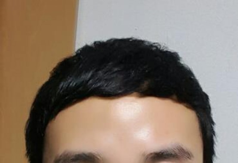 수술후 일주일 머리내렸을때.jpg