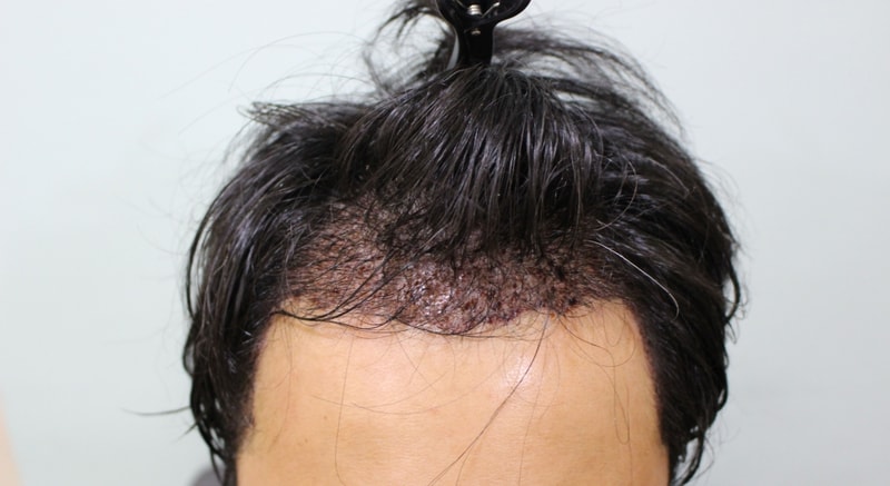 수술후 다음날 (1).JPG