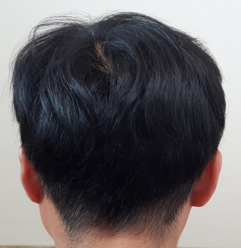 8개월 흉터이식.jpg