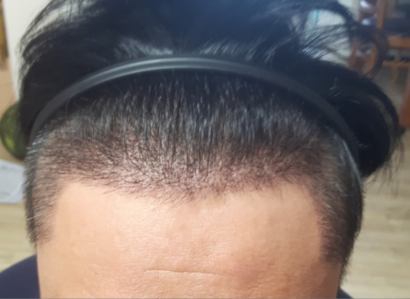 모재성 1900모낭(비절개) 수술18일 경과