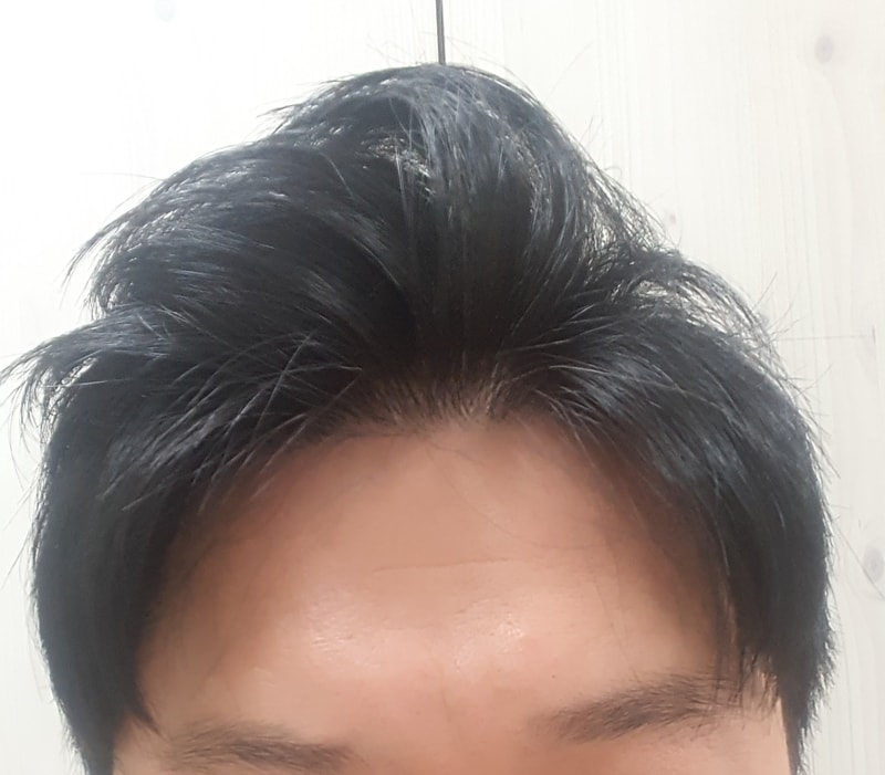 모재성 1900모낭 1년 7개월 경과