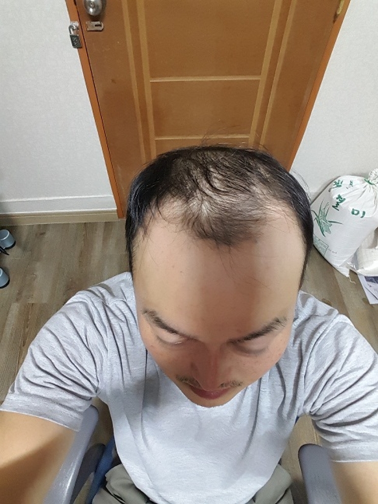 이식전.jpg
