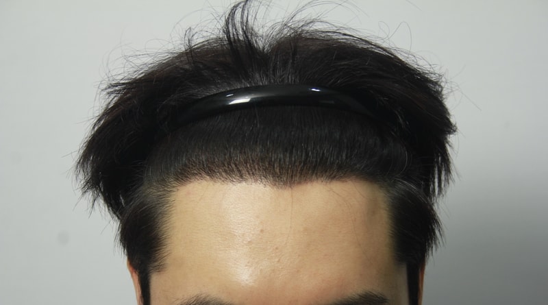 3주차경과 1.jpg