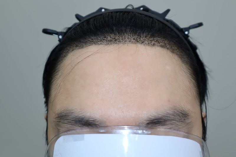 수술 후 2주 경과.jpg