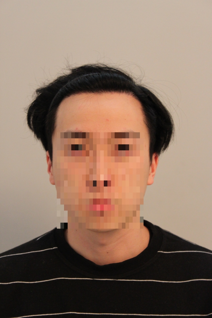 포헤어 비절개 구개월이에요