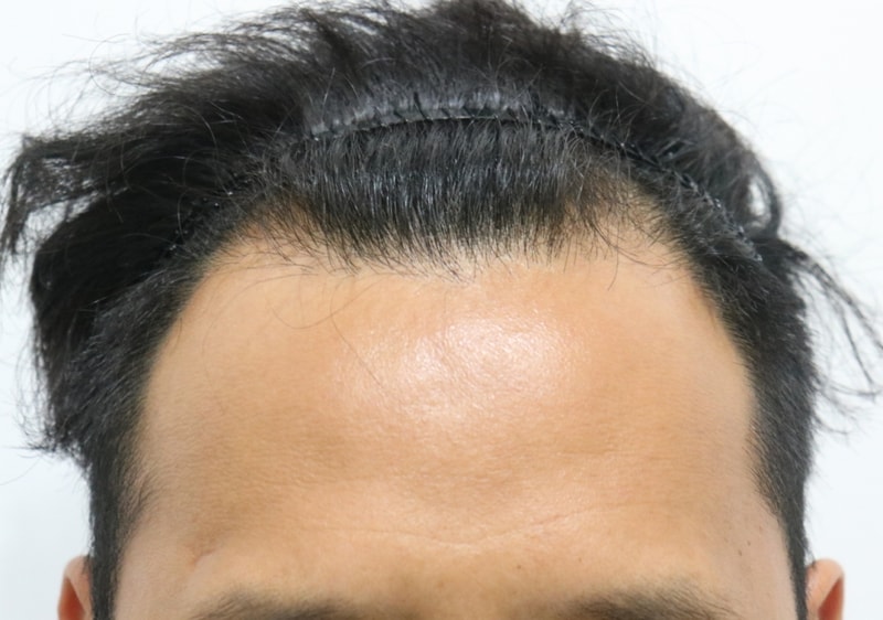 정면 수술전.jpg