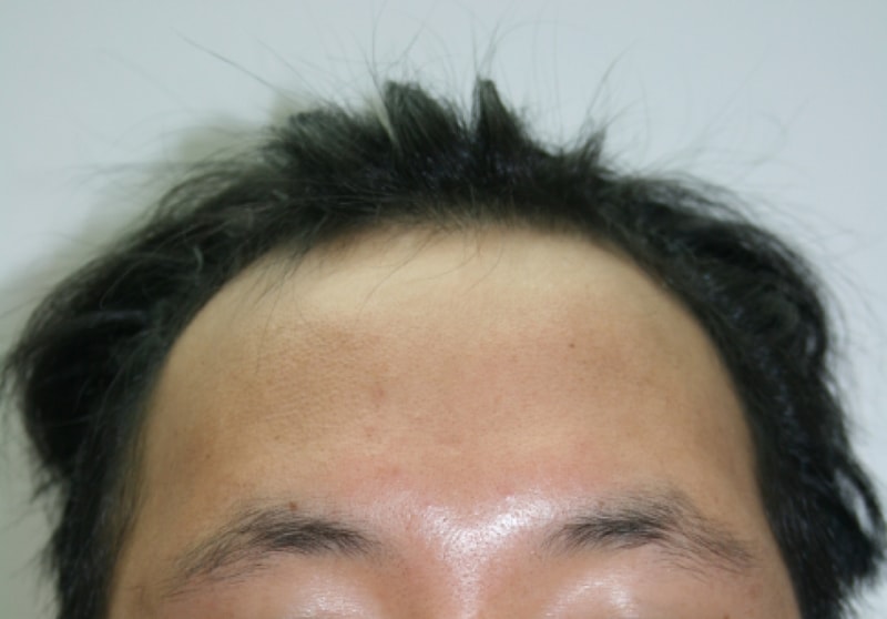 전두부 이식 1400모낭 7개월 되었습니다.