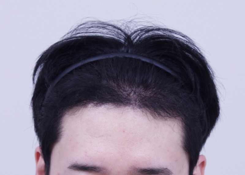 크기변환_수술후4개월 (2).JPG