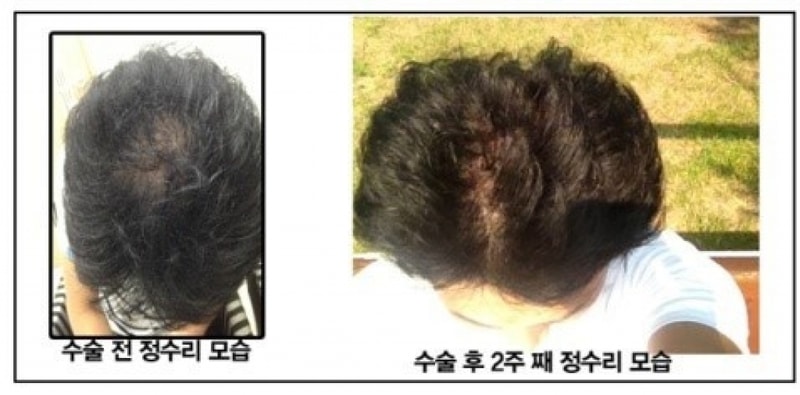 장승일 수술전 - 정수리.jpg