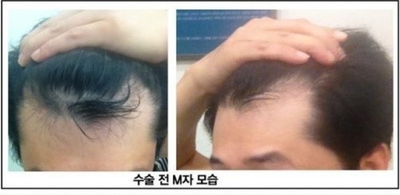 장승일 수술전1.jpg