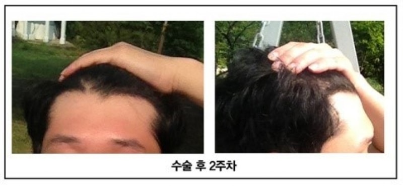 장승일 수술후 1 _m자.jpg