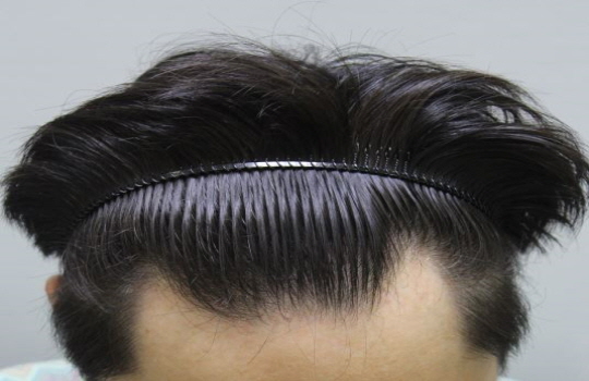 [크기변환]수술전.JPG