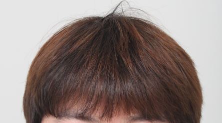 이식한지 11개월차 됐습니다.