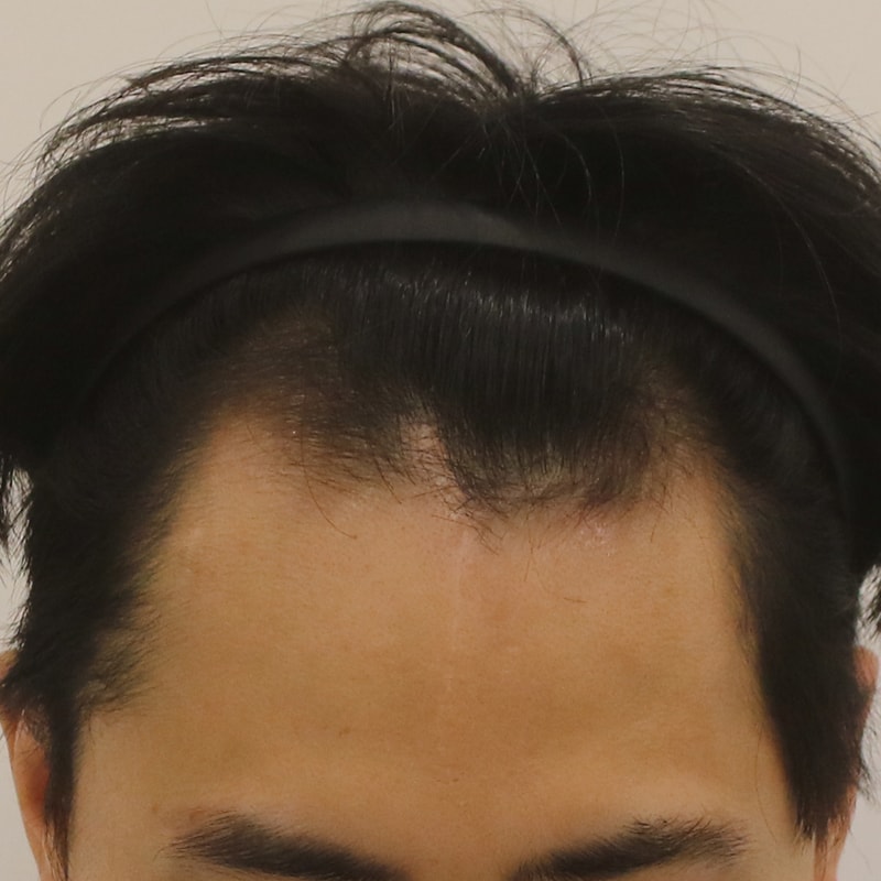 이식전.jpeg