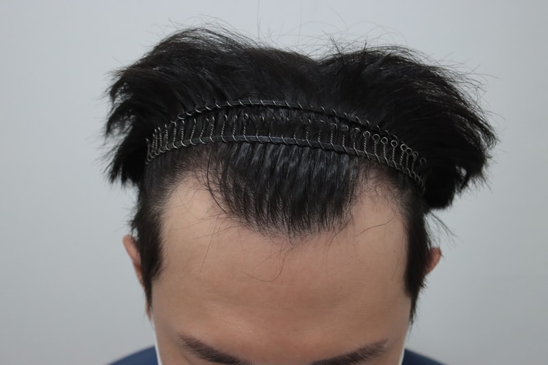 モストクリニック3500モ1日目のフォト体験談