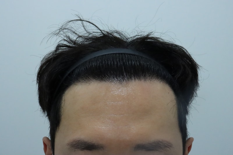 モーメントクリニック 3500モ 270日目 フォト体験談