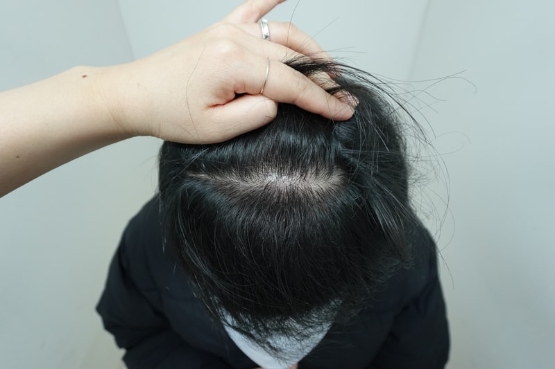 재수술 전두부.jpeg
